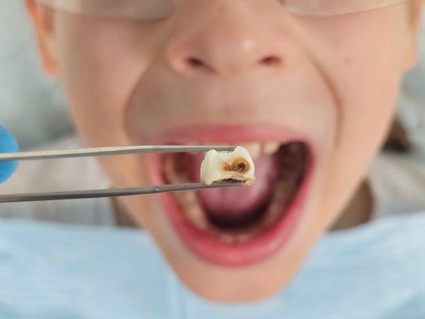Best Dentist for Tooth Abscess  in Fulda, MN